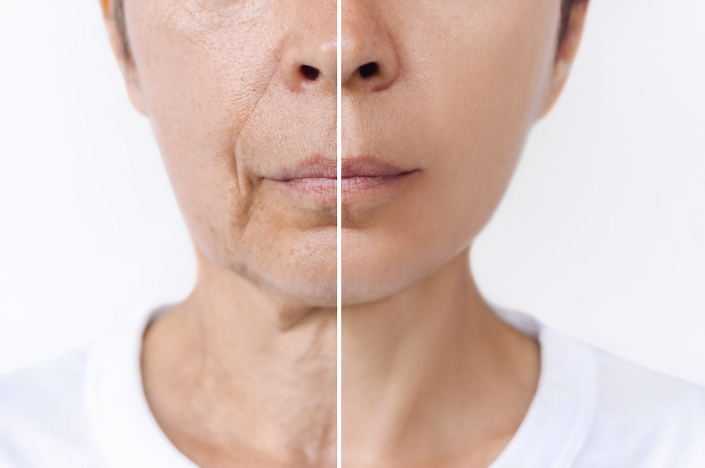 before-and-after close-up view of a patient's lower face, jawline, and neck, illustrating the structural correction and lifting results of a deep plane face lift in Connecticut.