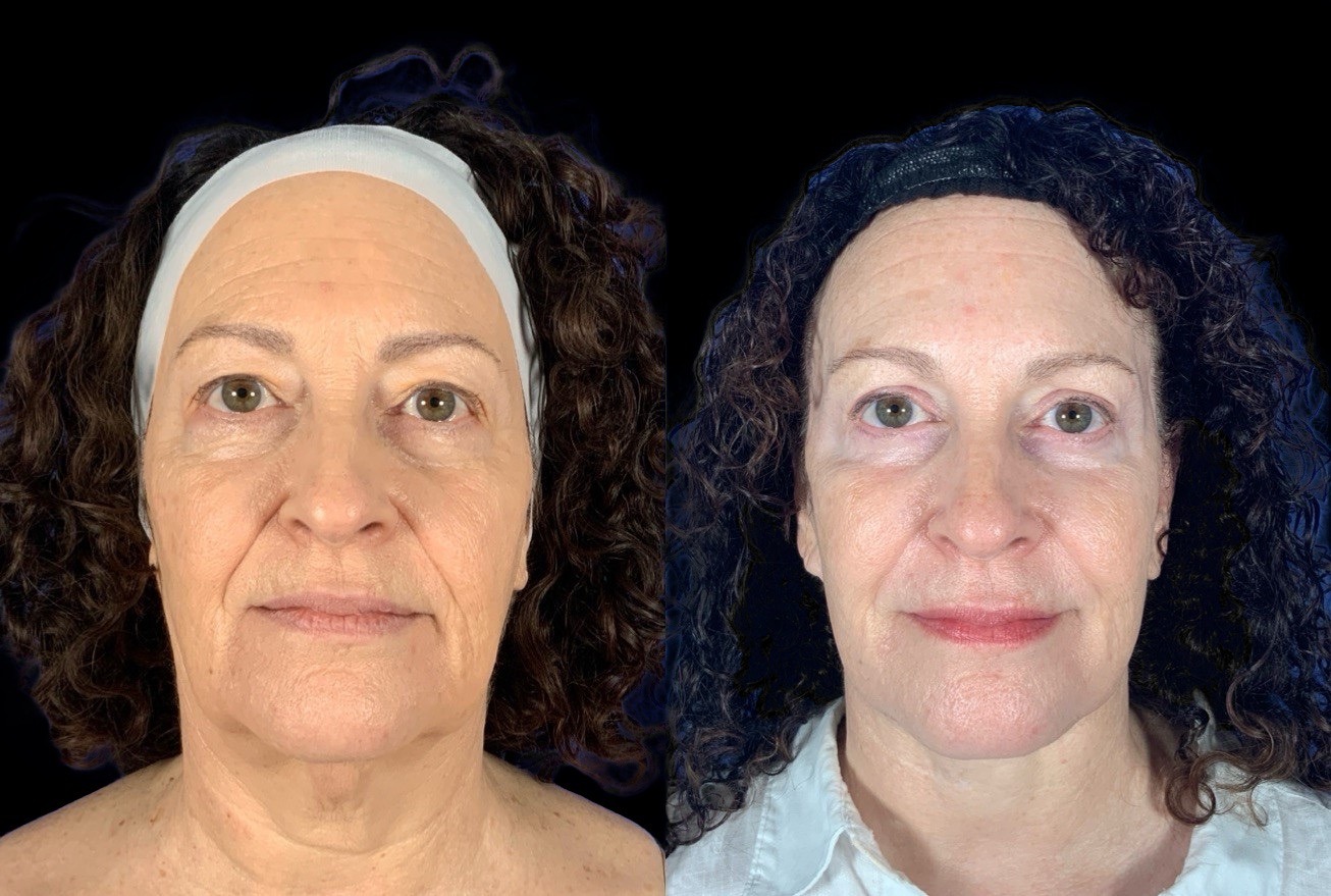 Case 146 before and after deep plane facelift with brow lift and eyelid surgery, front view (photo 1 of 6)