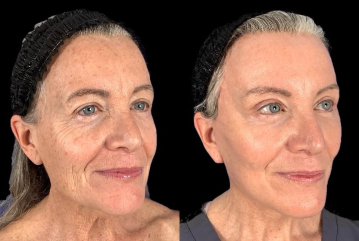 Facelift before and after, case 100