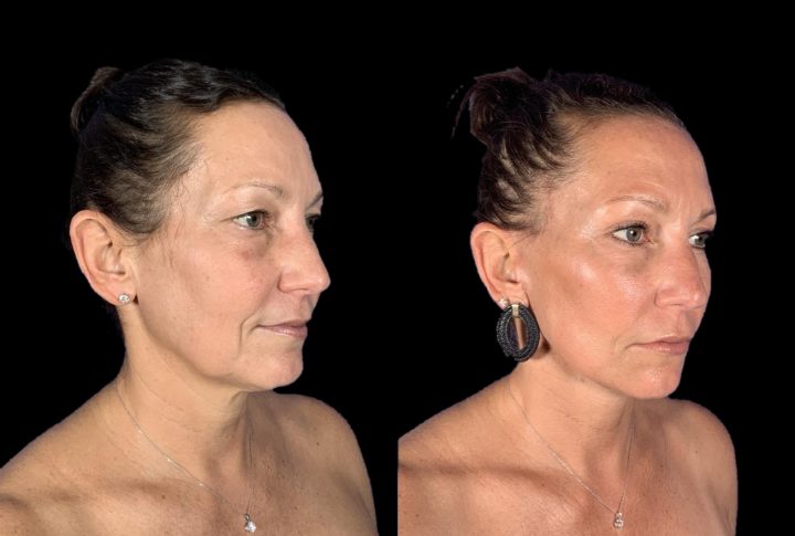 Facelift before and after photos, case 101, view 1