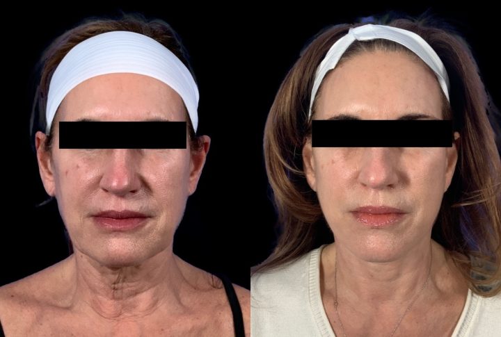 Facelift before and after, case 102