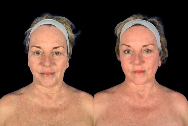 Facelift before and after, case 104