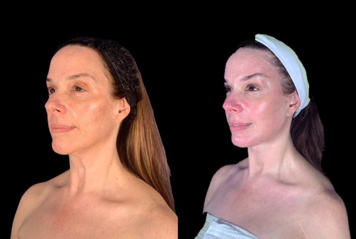 Facelift before and after, case 105