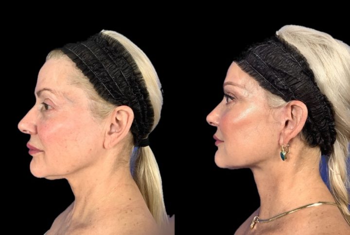Facelift before and after, case 109