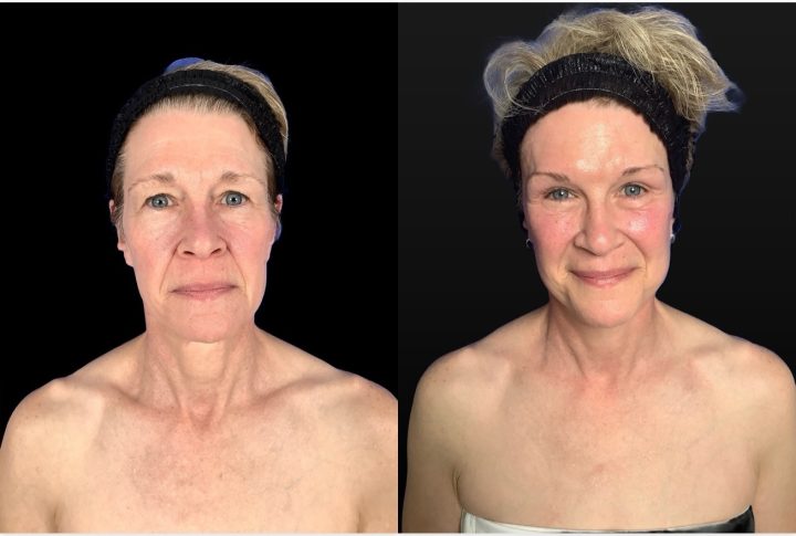 Facelift before and after, case 110