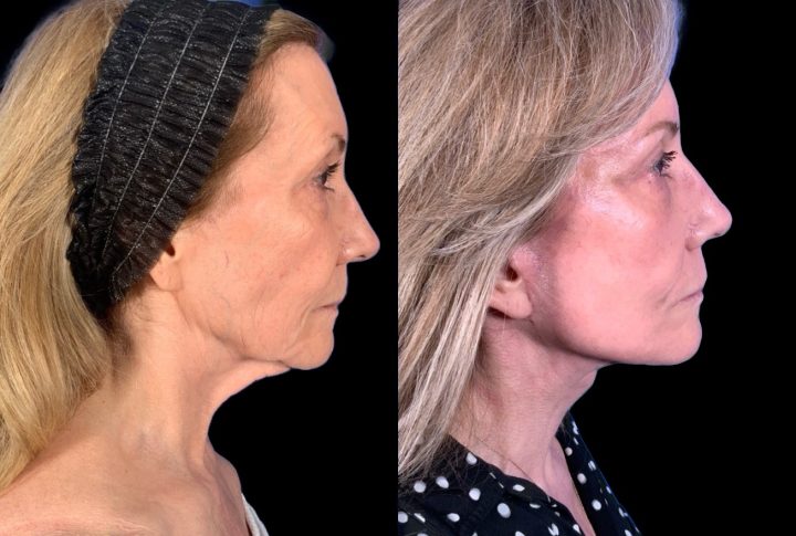 Facelift before and after, case 114