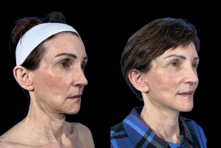 Facelift before and after, case 116