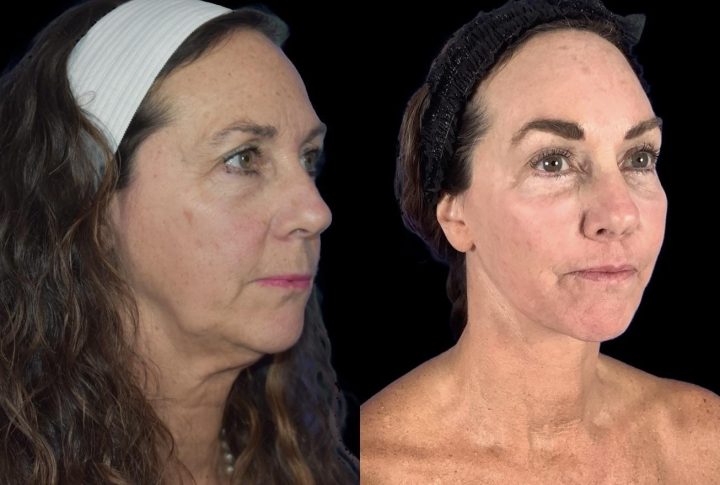 Facelift before and after, case 120