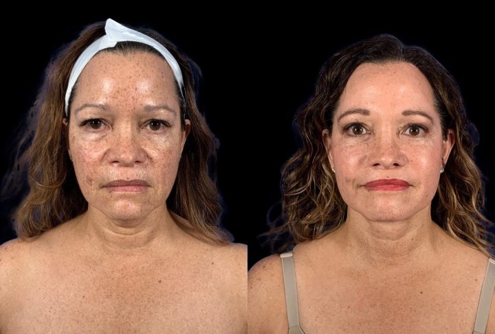 Facelift before and after, case 121