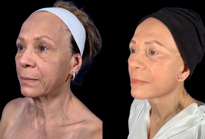Facelift before and after, case 122