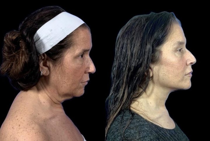 Facelift before and after, case 123