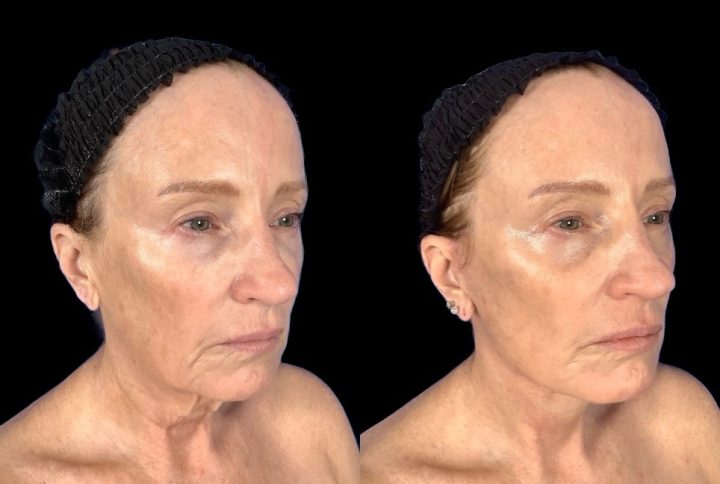 Facelift before and after, case 127
