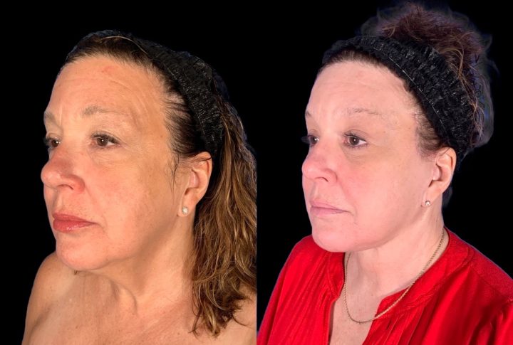 Facelift before and after, case 128