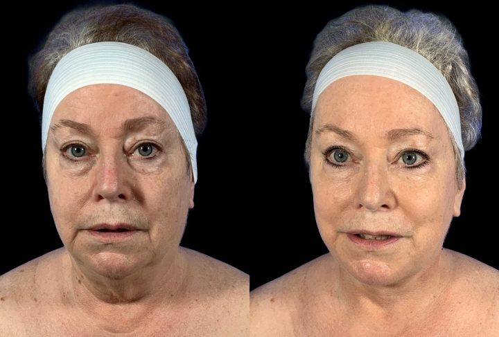 Facelift before and after, case 132