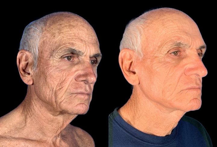 Facelift before and after, case 137