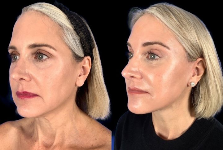 Facelift before and after, case 138