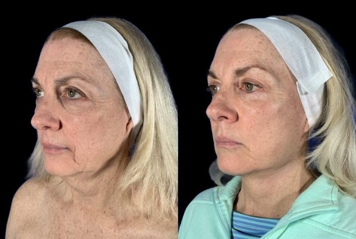 Case 142 before and after deep plane facelift with brow lift and upper eyelid surgery, three-quarter view (photo 1 of 5)