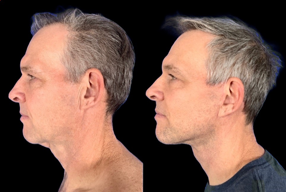 Case 143 before and after male deep plane facelift, left profile view