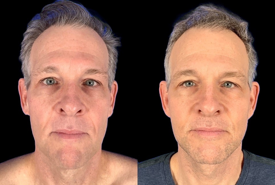 Case 143 before and after male deep plane facelift, front view