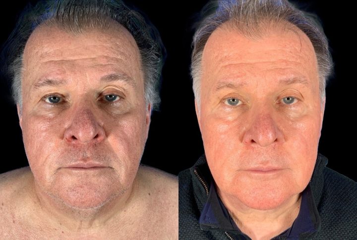 Case 144 before and after male lower face and neck lift, front view