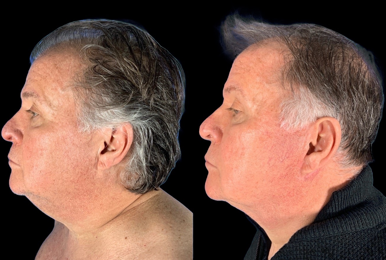 Case 144 before and after male lower face and neck lift, left profile view