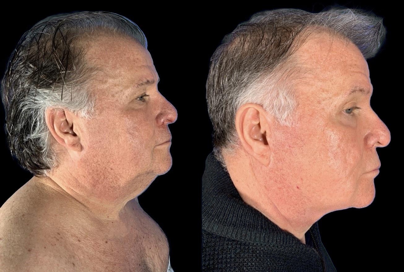 Case 144 before and after male lower face and neck lift, right profile view