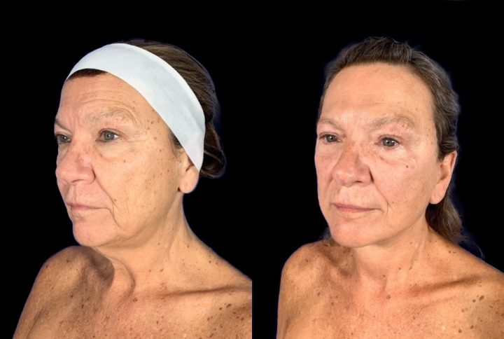 Case 147 before and after deep plane face and neck lift, three-quarter view (photo 1 of 5)
