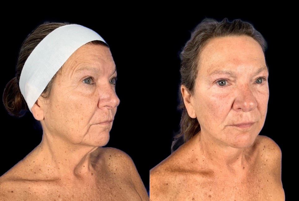 Case 147 before and after deep plane face and neck lift, three-quarter view (photo 4 of 5)