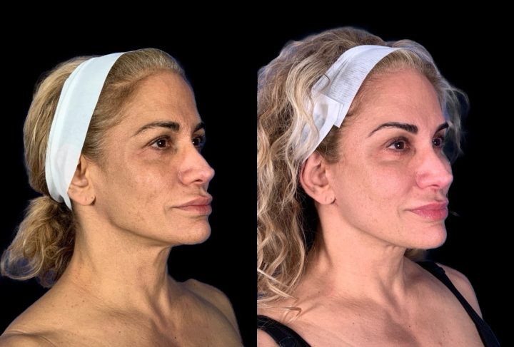 Case 148 before and after deep plane lower face and neck lift, three-quarter view (photo 1 of 6)