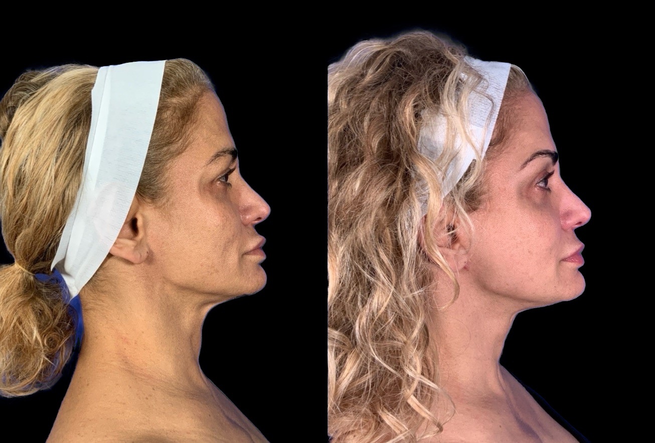 Case 148 before and after deep plane lower face and neck lift, right profile view