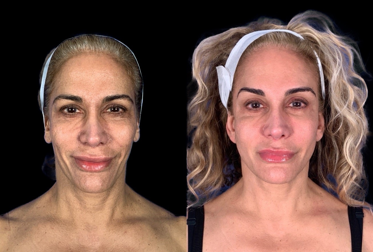 Case 148 before and after deep plane lower face and neck lift, front view