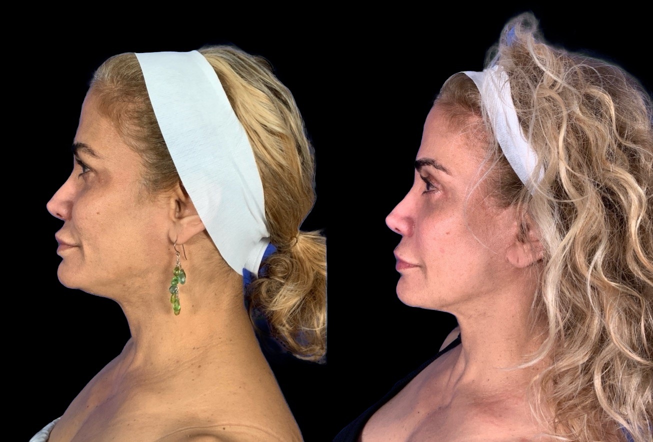 Case 148 before and after deep plane lower face and neck lift, left profile view
