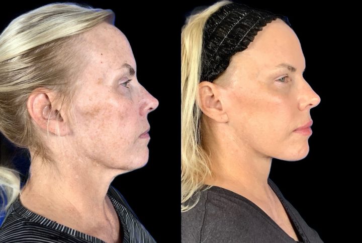 Case 149 before and after deep plane facelift with brow lift, right profile view