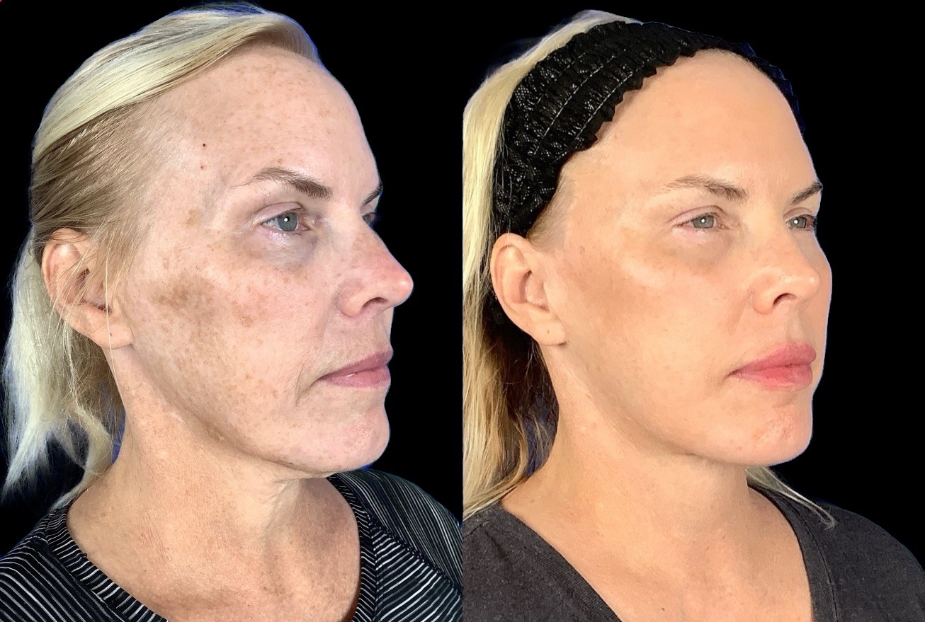 Case 149 before and after deep plane facelift with brow lift, three-quarter view (photo 3 of 5)