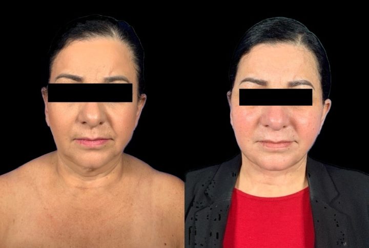 Case 151 before and after deep plane face and neck lift, front view