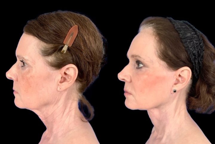 Case 156 before and after deep plane lower face and neck lift with subtle fat grafting, left profile view