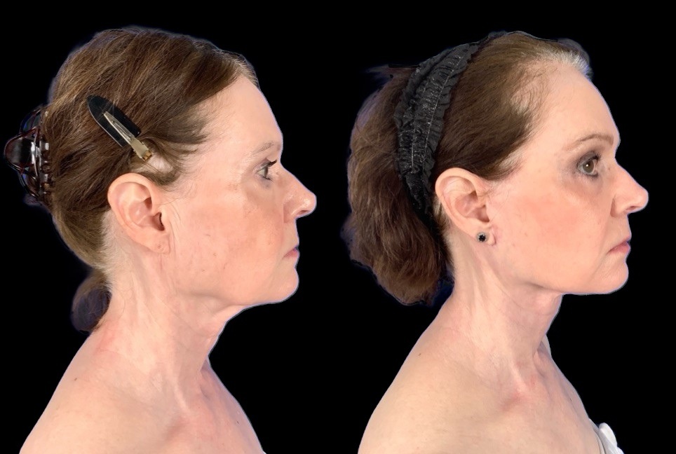 Case 156 before and after deep plane lower face and neck lift with subtle fat grafting, right profile view