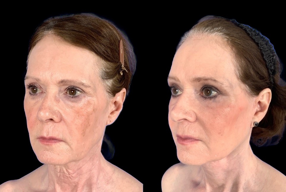 Case 156 before and after deep plane lower face and neck lift with subtle fat grafting, three-quarter view (photo 5 of 6)