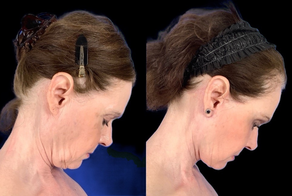 Case 156 before and after deep plane lower face and neck lift with subtle fat grafting, right profile view with head tilted down