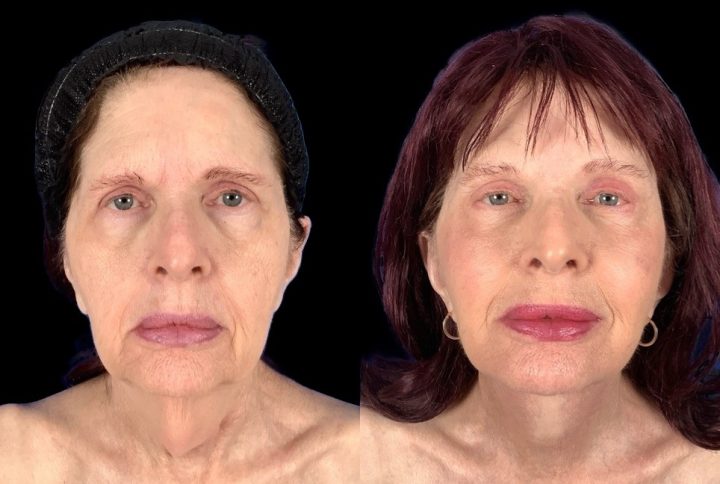 Case 159 before and after facial rejuvenation with a deep plane lower face and neck lift, front view