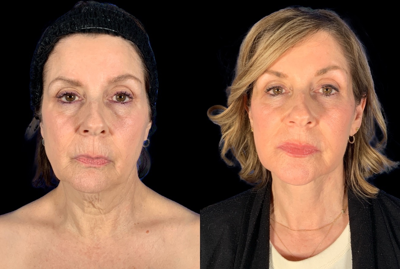 Case 160 before and after deep plane lower face and neck lift with fat grafting, front view