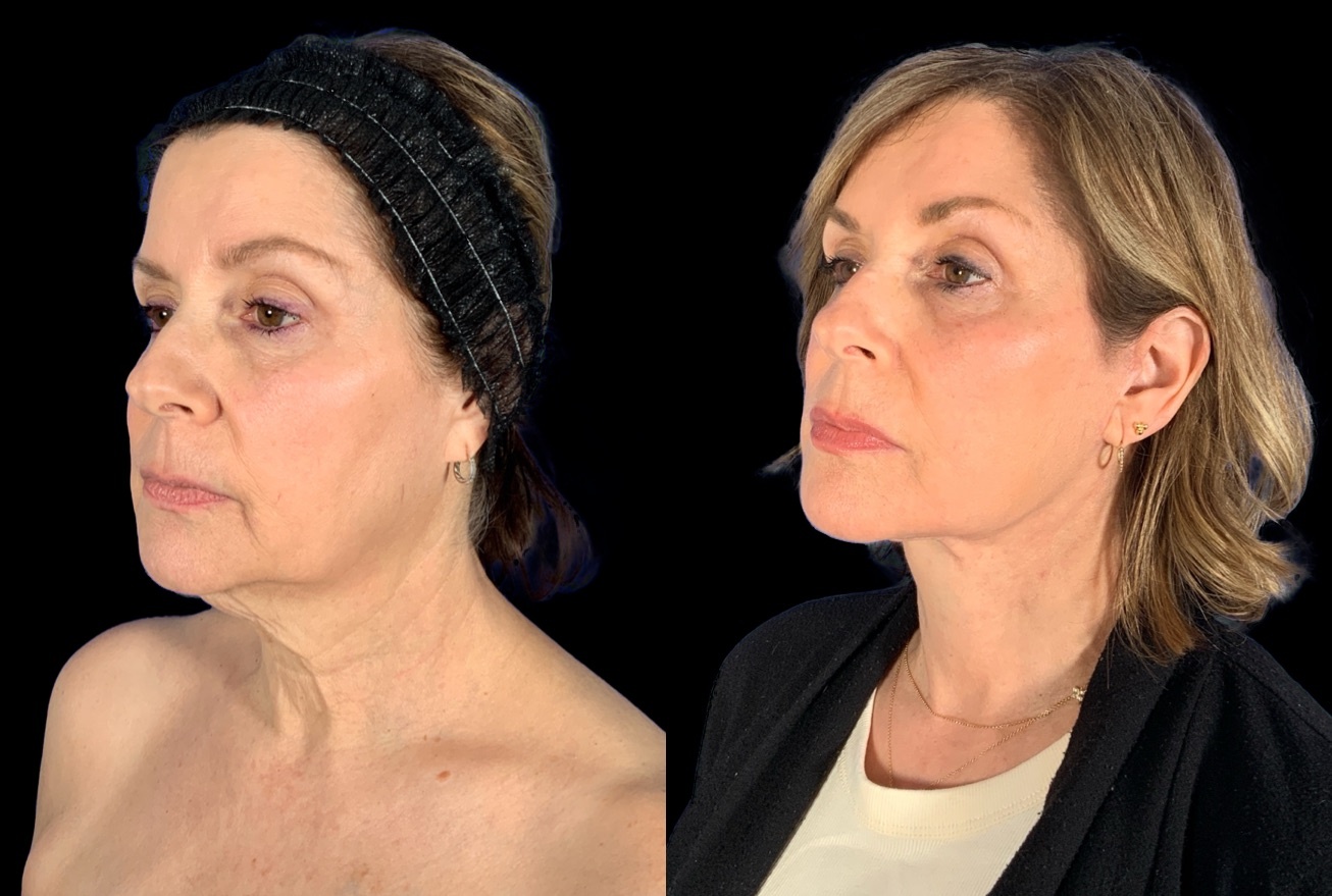 Case 160 before and after deep plane lower face and neck lift with fat grafting, three-quarter view (photo 2 of 5)