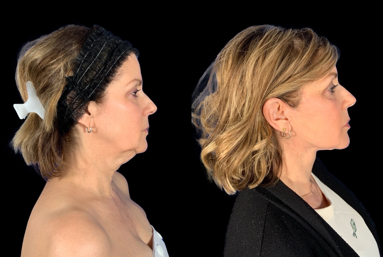 Case 160 before and after deep plane lower face and neck lift with fat grafting, right profile view