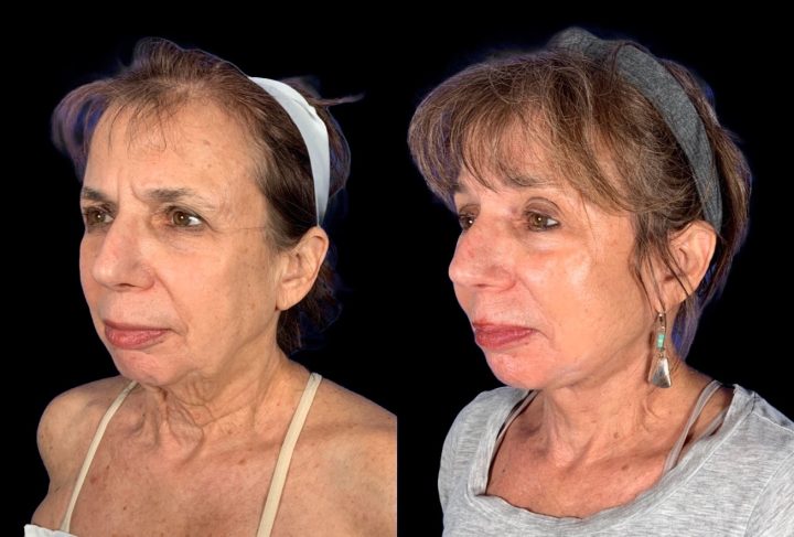 Case 161 before and after deep plane lower face and neck lift without a chin implant, three-quarter view (photo 1 of 10)