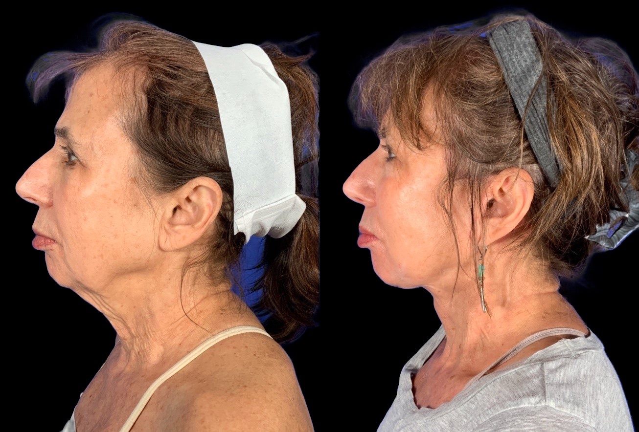 Case 161 before and after deep plane lower face and neck lift without a chin implant, left profile view (photo 3 of 10)