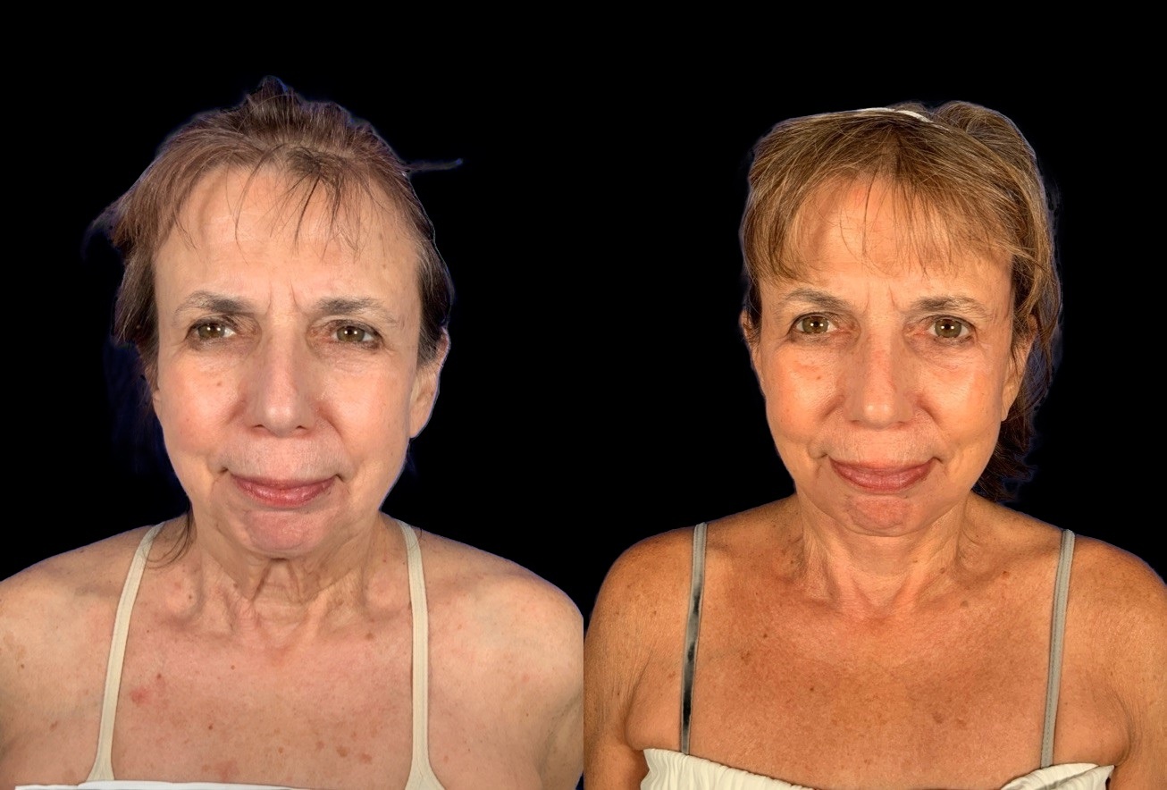 Case 161 before and after deep plane lower face and neck lift without a chin implant, front view (photo 8 of 10)