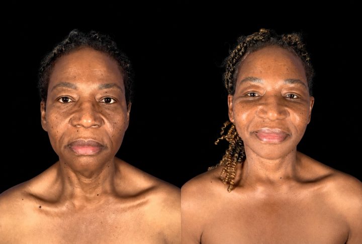 Case 163 before and after deep plane facelift and neck contouring, front view, after photo taken two weeks postoperative