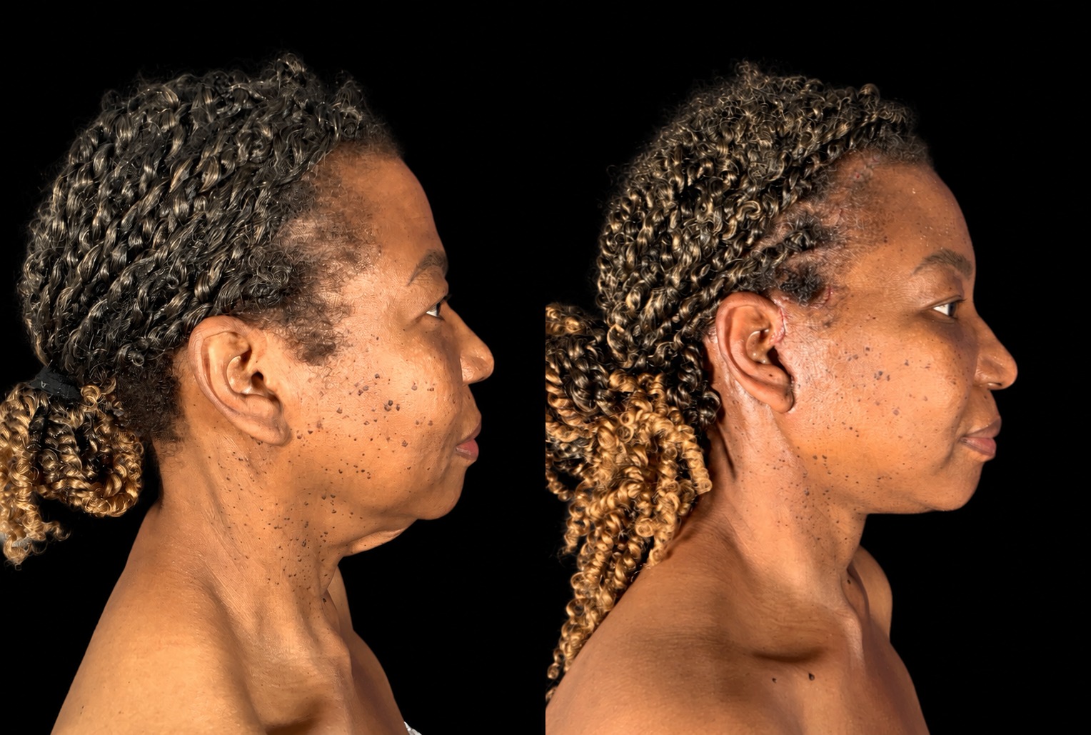 Case 163 before and after deep plane facelift and neck contouring, right profile view, after photo taken two weeks postoperative